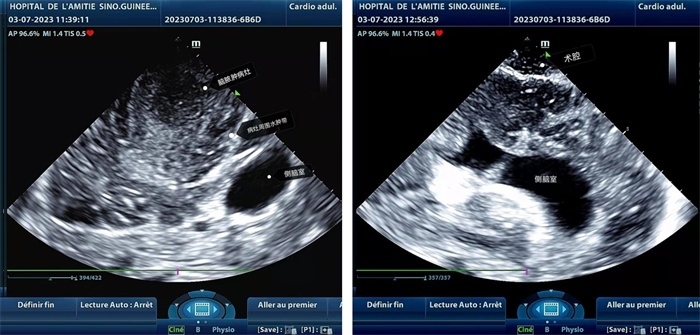 左圖顯示術(shù)中超聲見囊實性病變，大小約為4x4x3cm，病灶周圍腦組織水腫明顯；右圖為病灶切除后，術(shù)中超聲示術(shù)腔無病變殘留