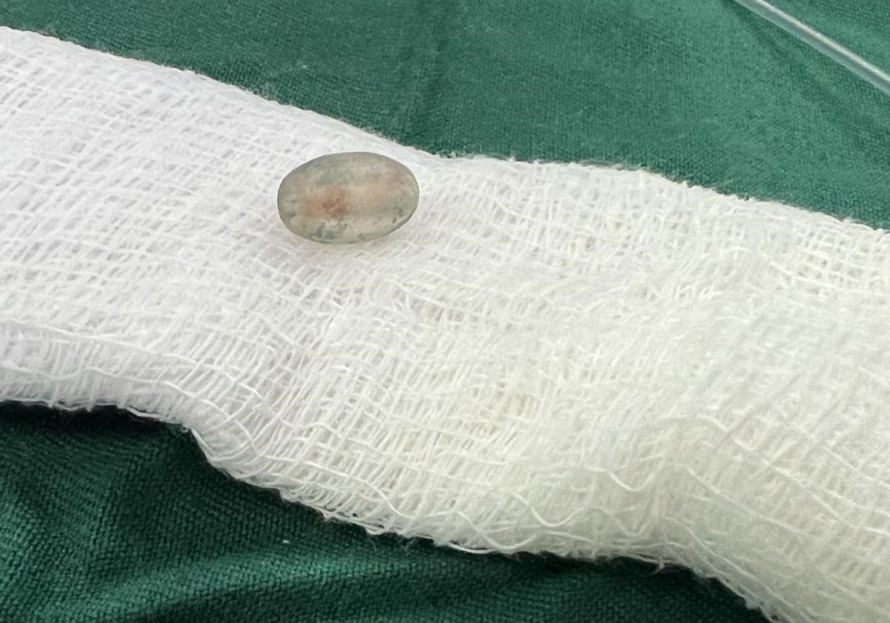 被取出的異物。中國援桑醫(yī)療隊供圖