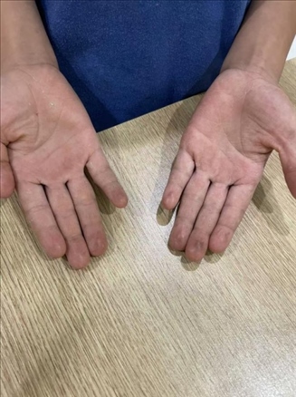 9歲小學生長期拍煙卡，手部粗糙長繭。受訪者供圖