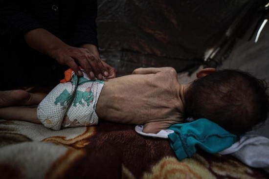 這是5月28日在加沙城西部一處臨時(shí)安置點(diǎn)拍攝的一名營養(yǎng)不良的嬰兒。新華社發(fā)（馬哈茂德·扎基攝）